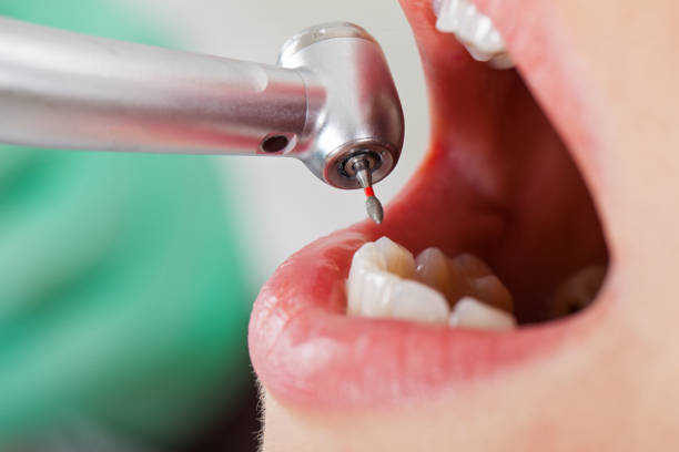 Best Emergency Tooth Extraction in East Bernard, TX